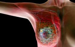 研究人员确定了导致乳腺癌治疗耐药性的过程