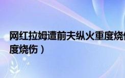 网红拉姆遭前夫纵火重度烧伤图片（网红拉姆遭前夫纵火重度烧伤）