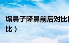 塌鼻子隆鼻前后对比照片（塌鼻子隆鼻前后对比）