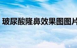 玻尿酸隆鼻效果图图片（玻尿酸隆鼻效果图）