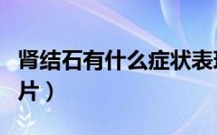 肾结石有什么症状表现（肾结石有什么症状图片）