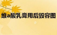 维a酸乳膏用后毁容图（维a酸乳膏用后毁容）