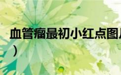 血管瘤最初小红点图片（婴儿毛细血管瘤图片）