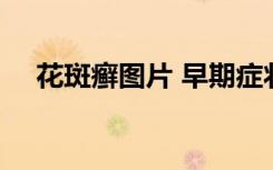 花斑癣图片 早期症状 初期 白斑（花斑）