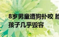 8岁男童遭狗扑咬 脸上缝了90多针，母亲：孩子几乎毁容