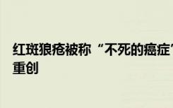 红斑狼疮被称“不死的癌症”，要一生面对，每次复发都是重创