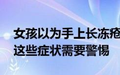 女孩以为手上长冻疮却被确诊红斑狼疮 出现这些症状需要警惕