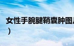女性手腕腱鞘囊肿图片（手腕腱鞘囊肿的危害）