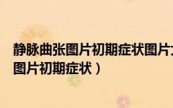 静脉曲张图片初期症状图片大连航天在什么地方（静脉曲张图片初期症状）