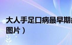 大人手足口病最早期症状（大人手足口最早期图片）