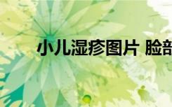 小儿湿疹图片 脸部（小儿湿疹图片）