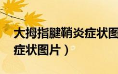 大拇指腱鞘炎症状图片 治疗（大拇指腱鞘炎症状图片）