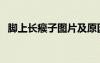 脚上长瘊子图片及原因（脚上长瘊子图片）
